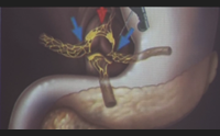 tumore al pancreas fa meno paura speranze dalla eco endoscopia