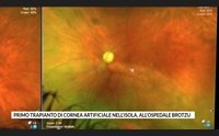 primo trapianto di cornea artificiale nell isola all ospedale brotzu