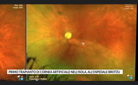 primo trapianto di cornea artificiale nell isola all ospedale brotzu